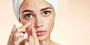 Các bước skincare cơ bản dành cho da mụn